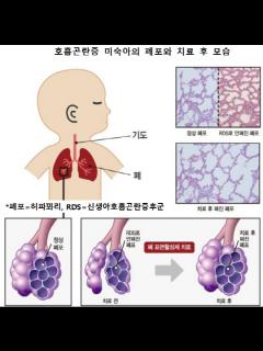[x]미숙아 호흡곤란증후군 치료 합성신약 개발