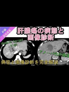 [x]肝膿瘍の病態と画像診断 - YouTube