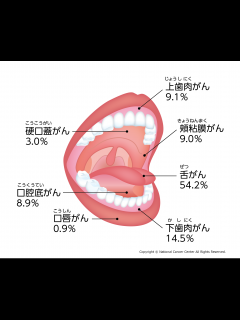 [x]口腔がんの原因・症状について｜国立がん研究センター